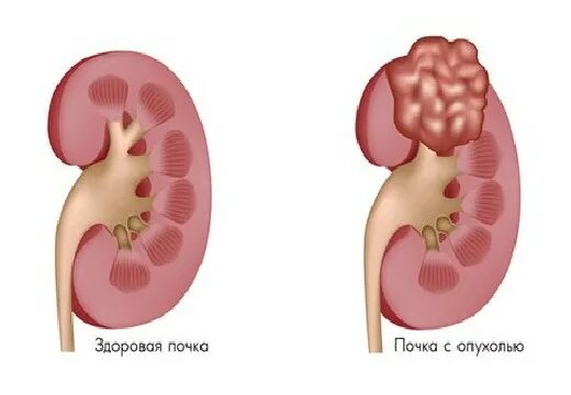 УЗИ почек гестационный пиелонефрит. Ангиомиолипома почки макропрепарат. Гестационный пиелонефрит почка. Липома и ангиомиолипома почки. Опухоль почек у женщин