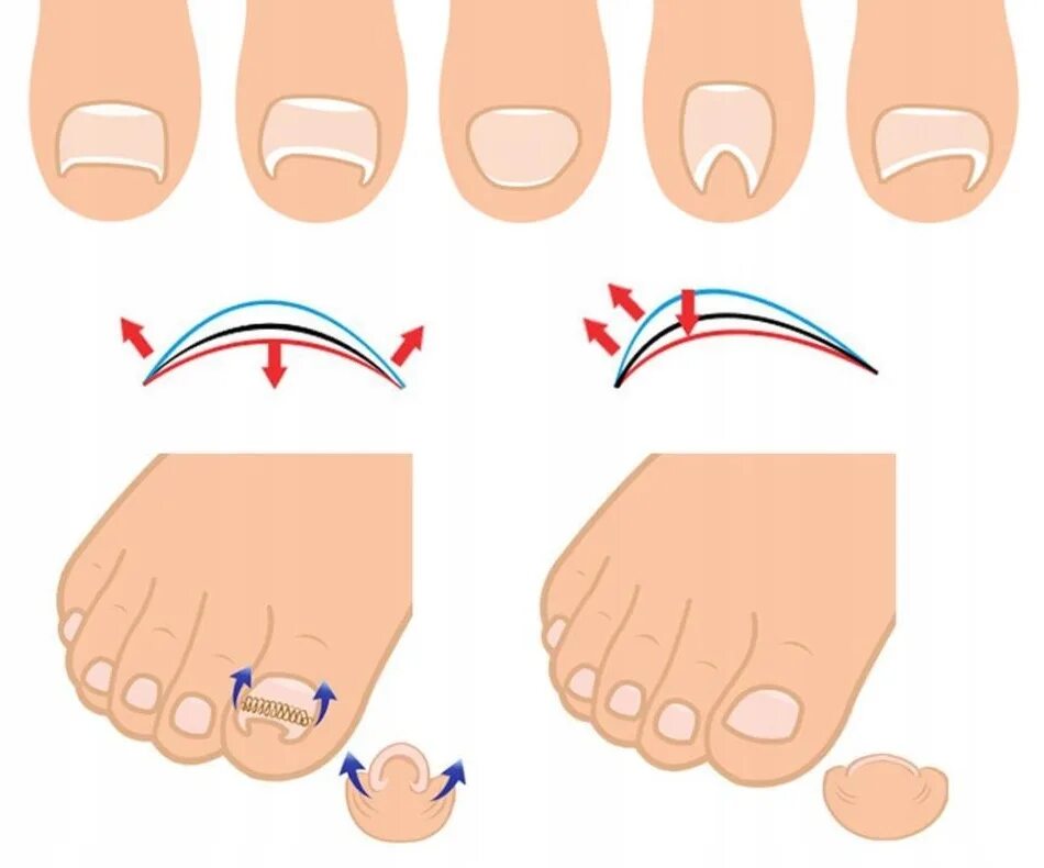Ногтевой валик на ноге. Исправление вросшего ногтя на ноге.