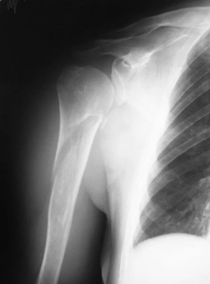 ушиб левого плечевого сустава мкб 10. ушиб плечевой кости. переломы конечностей классификация. кистовидная перестройка головки плечевой кости на рентгене. контузия головки плечевой кости.