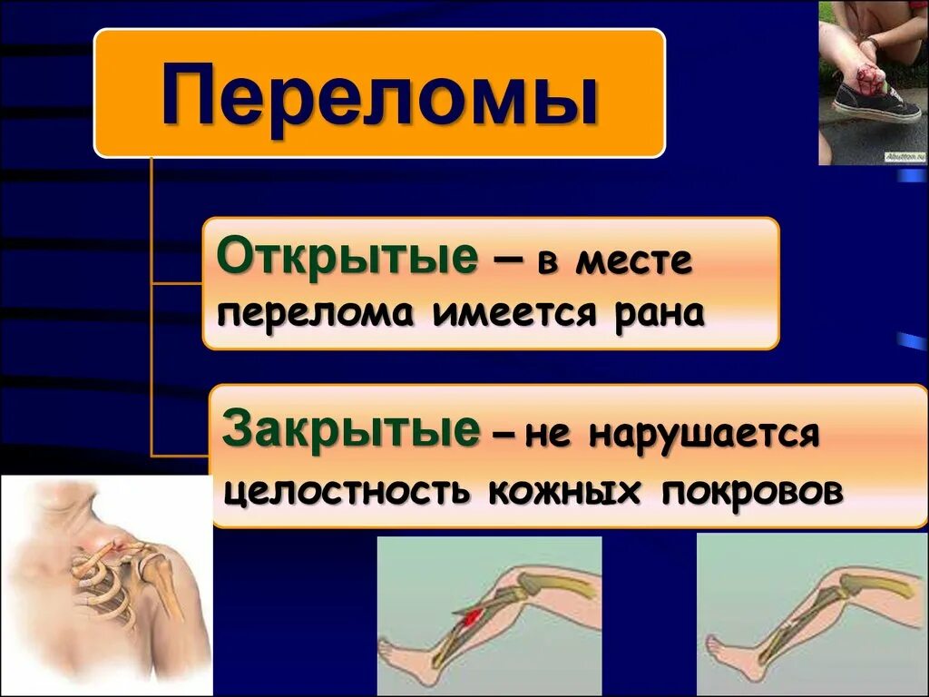 Переломы презентация по ОБЖ. Первая помощь при травмах презентация.