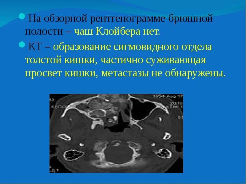 Опухоль ободочной кишки на кт. Образование сигмовидной кишки на кт. Кт брюшной полости метастазы. Образование ободочной кишки на кт.