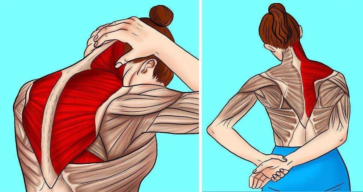 Как убрать трапециевидную мышцу