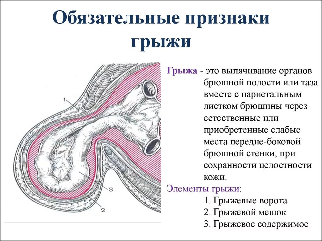 Как определить грыжу