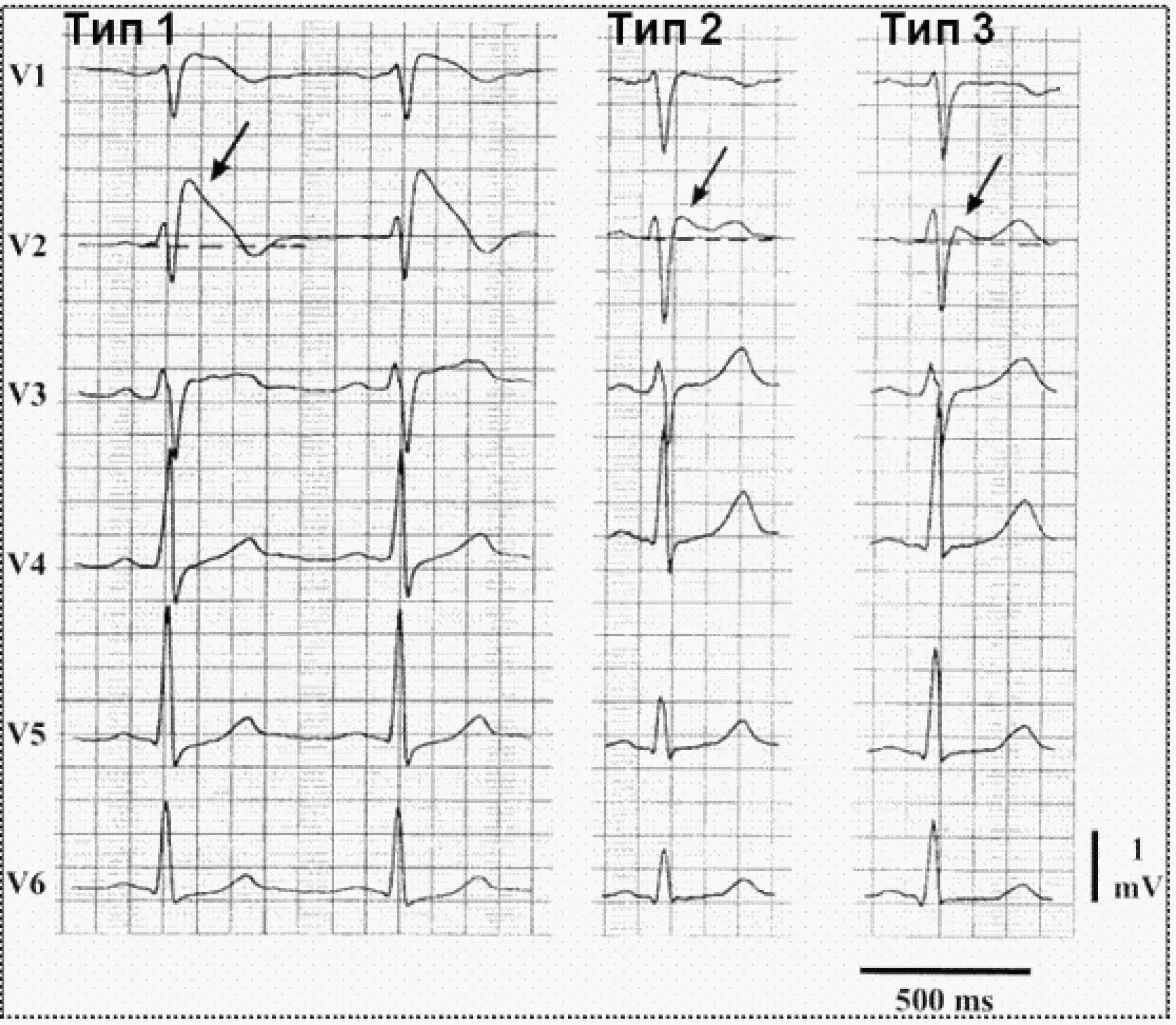 Мв на экг. Синдром Бругада Тип 2 ЭКГ. Синдром Бругада на ЭКГ. Синдром Бругада 1 Тип. Синдром Бругада Тип 1 2.
