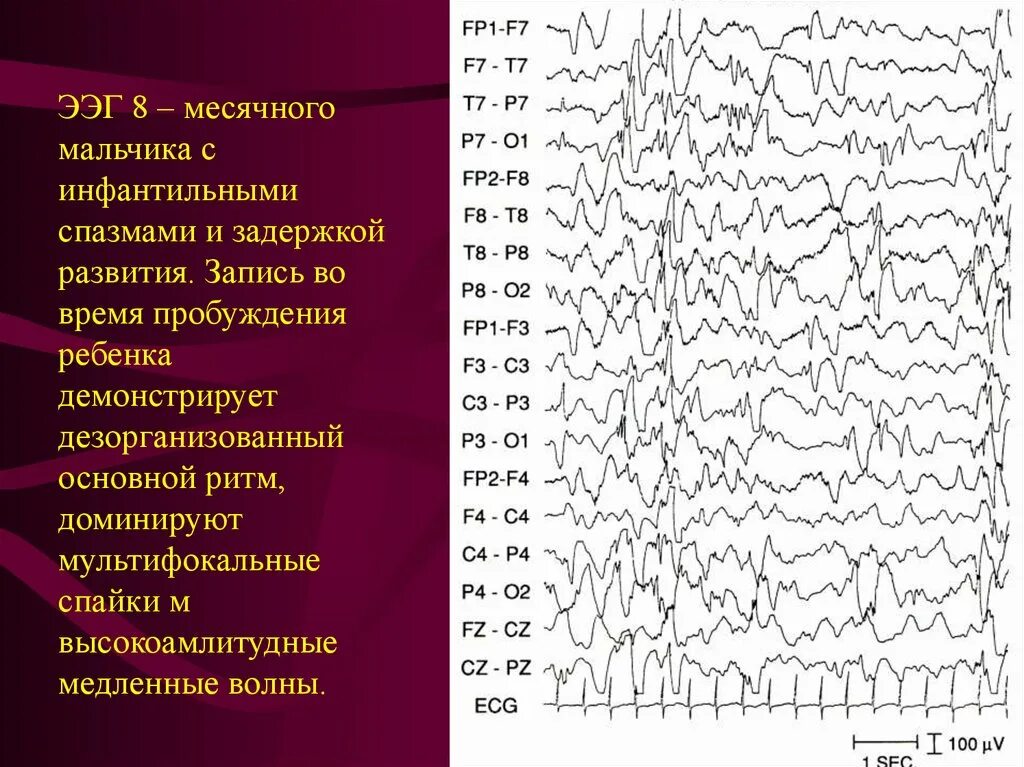 Активность ээг у ребенка что это. Эпилептические паттерны на ЭЭГ. Спайк волновая активность на ЭЭГ. Умственная отсталость на ЭЭГ. Сонные веретена и к-комплексы на ЭЭГ.