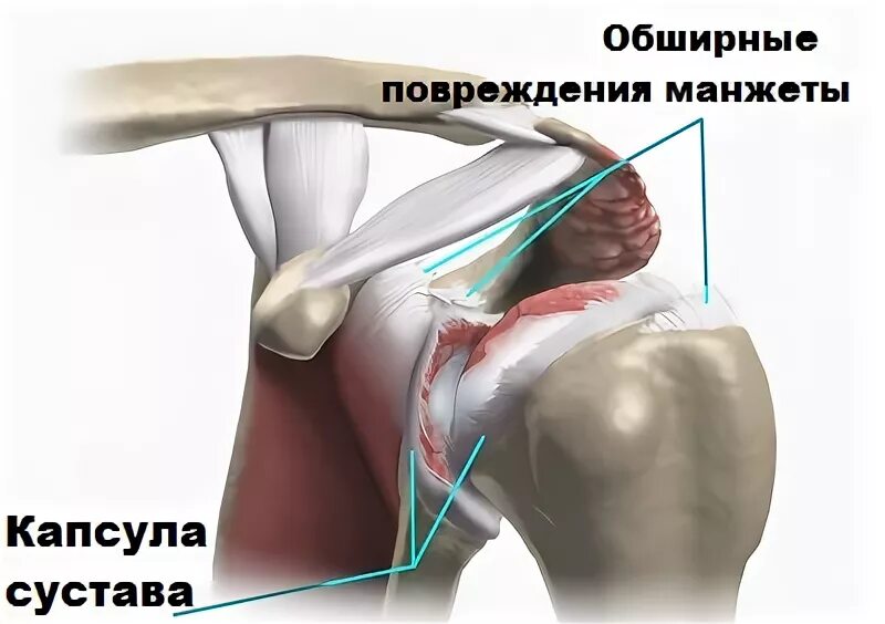 Ротаторная манжета плечевого сустава разрыв. Повреждения плеча вращательной манжеты s46. Ротаторная манжета плечевого сустава анатомия. Дебридмент вращающей манжеты плечевого сустава.