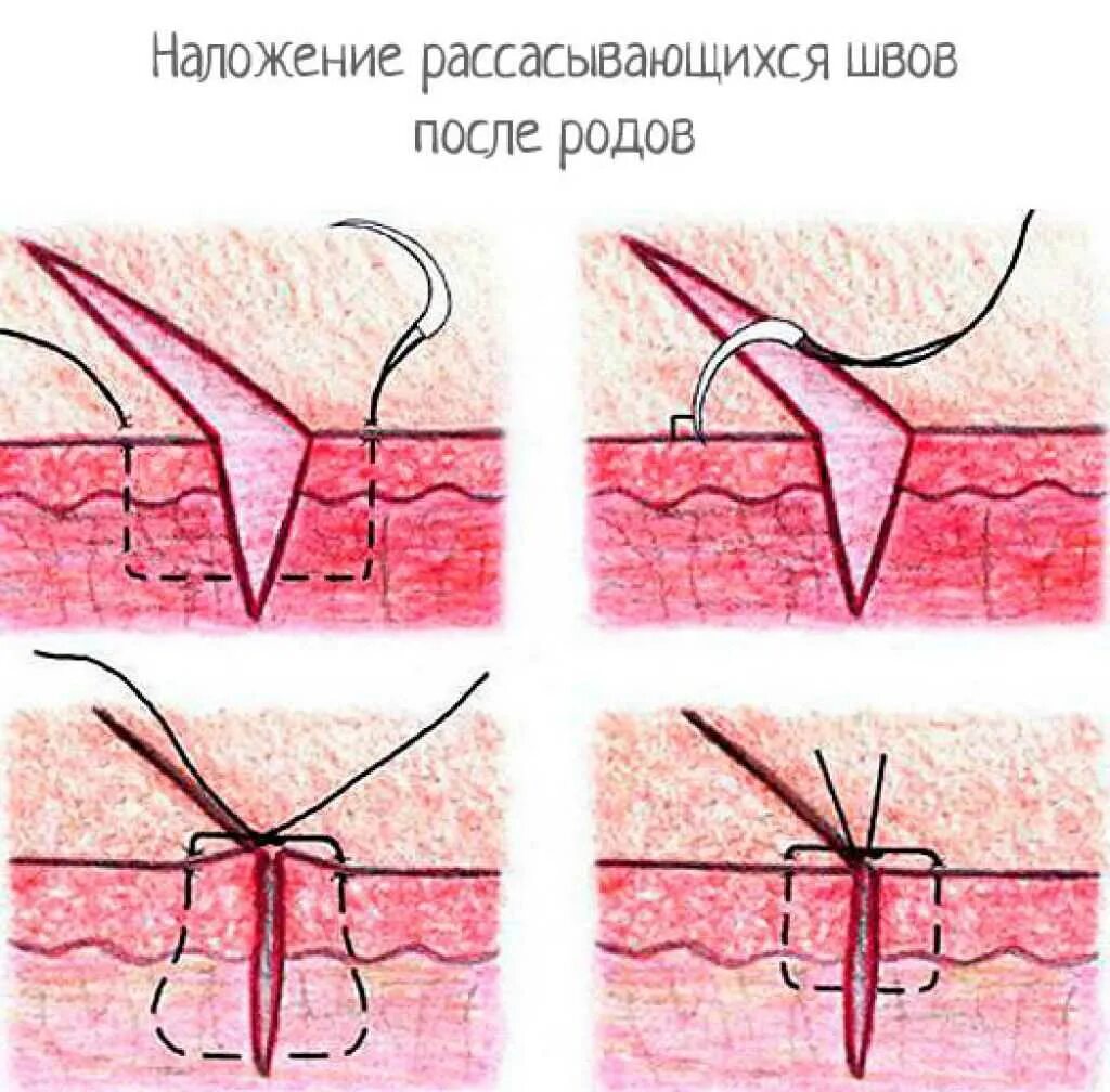 Саморассасывающиеся нити для швов. Шов саморассасывающиеся нитки хирургический. Шов саморассасывающимися нитками. Шовный материал для кесарева сечения.