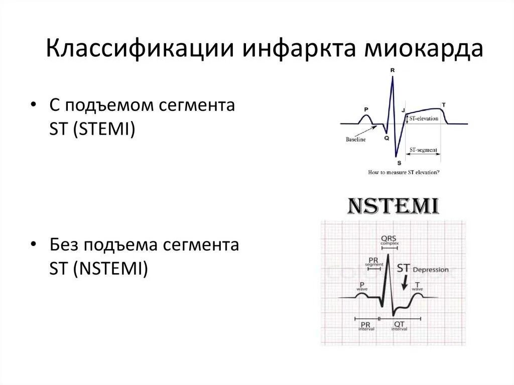 Острый коронарный синдром инфаркт. ЭКГ инфаркт миокарда без подъема St. Коронарный синдром на ЭКГ. Инфаркт миокарда на ЭКГ С подъемом ст. ЭКГ при инфаркте миокарда без подъема сегмента St.