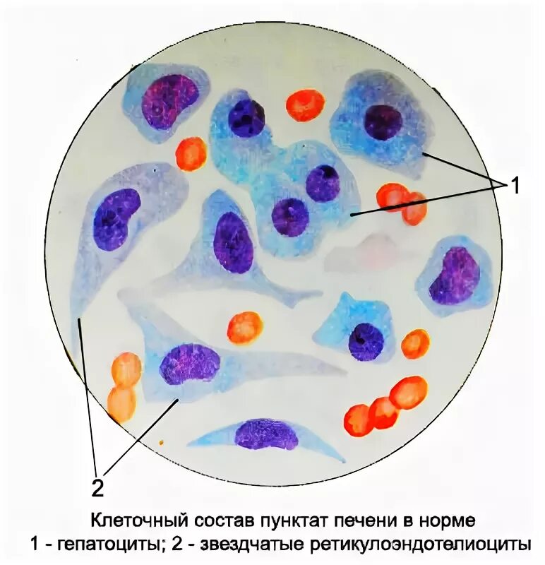 Цитологическое исследование пунктата. Лимфатический узел цитология. Звездчатные ретикулоэндотелициты. Звёздчатый РЕТИКУЛА ндотелиациты. Ретикулоэндотелиоциты печени.