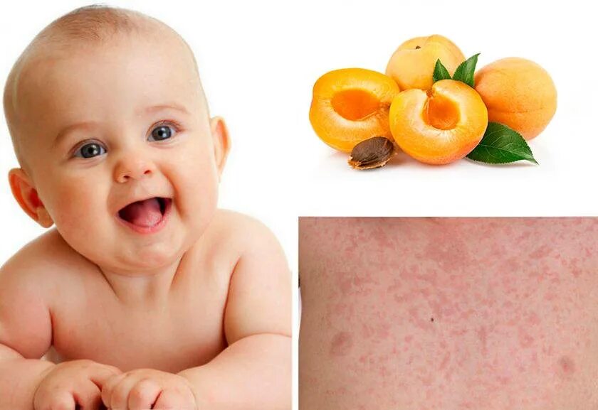Реб 6. Пищевая аллергия сыпь у грудничка. Пиуевая аллергия у ребёнка.