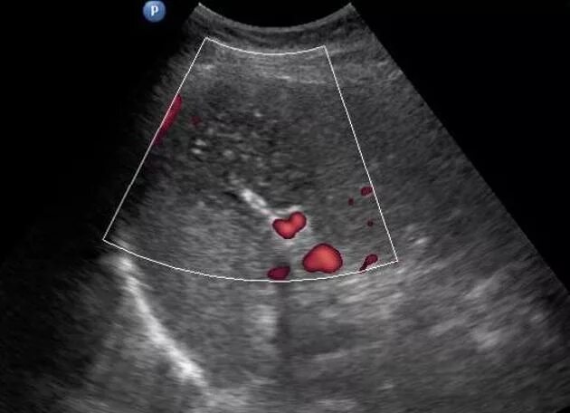 Гемангиосаркома селезенки УЗИ. Инфаркт селезенки УЗИ картина. Распад селезенки