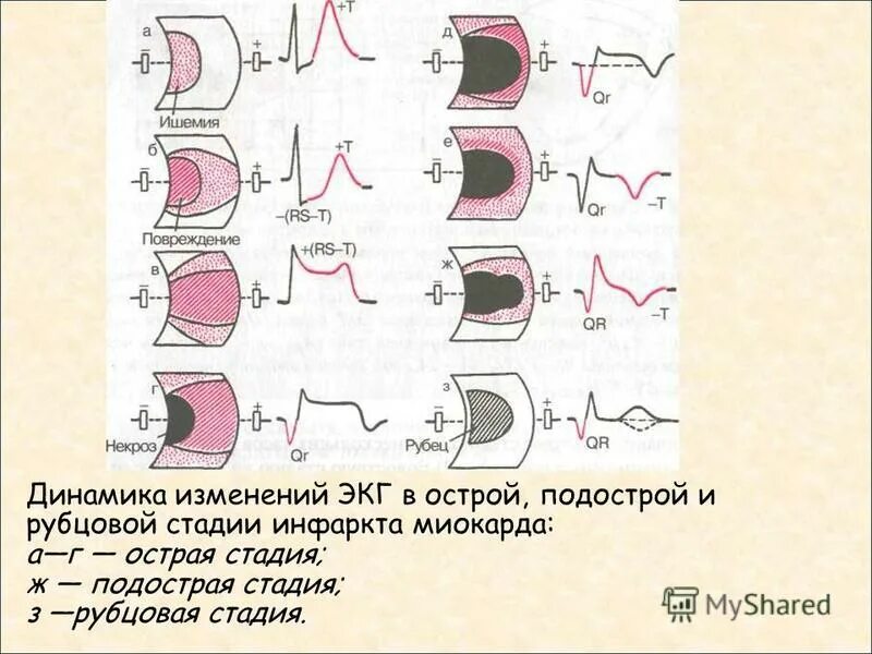 подострый инфаркт миокарда на экг