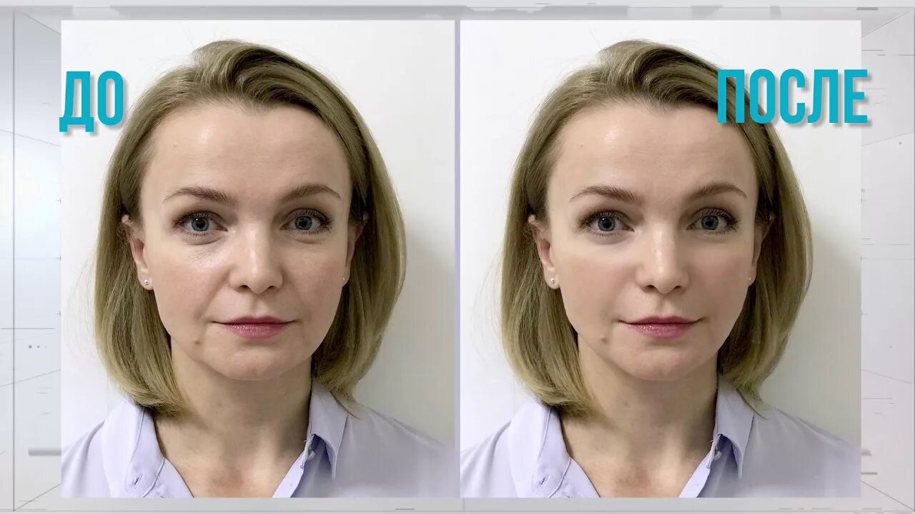 Нити визаж. Нитевой лифтинг нитями aptos (light life, visage, body, needle 2g, tread 2g). нити aptos excellence visage фото до и после. врачебная косметология до и после. нити аптос боди для подтяжки лица.