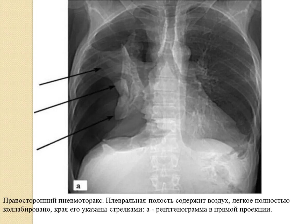 Коллабированное легкое при пневмотораксе. Пневмогидроторакс рентгенограмма. легкое коллабировано. коллабированное легкое на рентгене. коллабировано это лёгкое что.