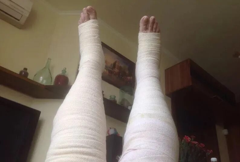 Сломанная нога в гипсе женская. Гипс на 2 ногах. Гипс на 2 ногах. Перелом берцовой кости гипс. Гипс на 2 ногах.