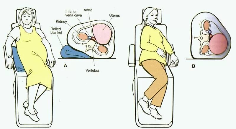 Полая Вена при беременности. Положение при беременности. Сидячие позы для беременных. Положение сидя при беременности. Спала перед родами