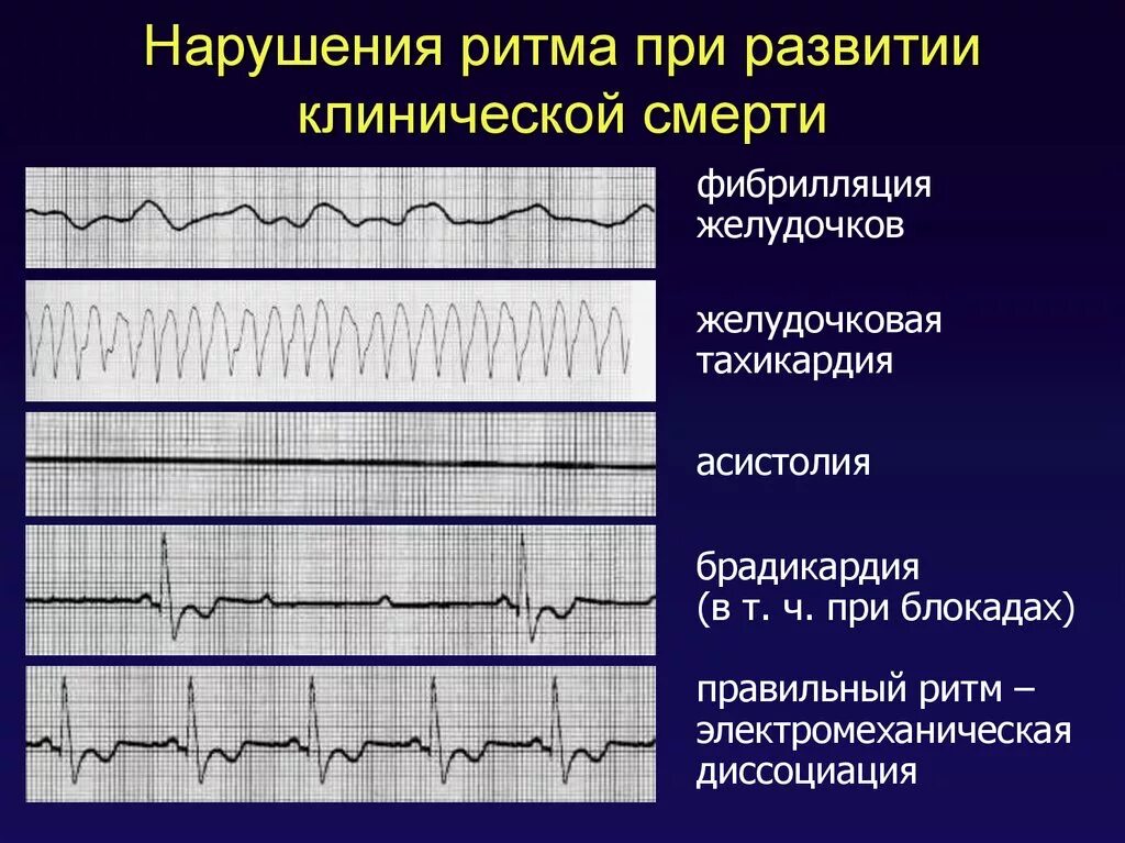 Ритм при фибрилляции желудочков. На ЭКГ клиническая смерть фибрилляция желудочков. ЭКГ при фибрилляции желудочков. Стоматологические аспекты фибрилляции желудочков.