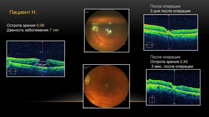 Макулярный разрыв после операции. Макулярный разрыв классификация. Ламеллярный макулярный разрыв окт. Макулярный разрыв окт. Сквозной макулярный разрыв.