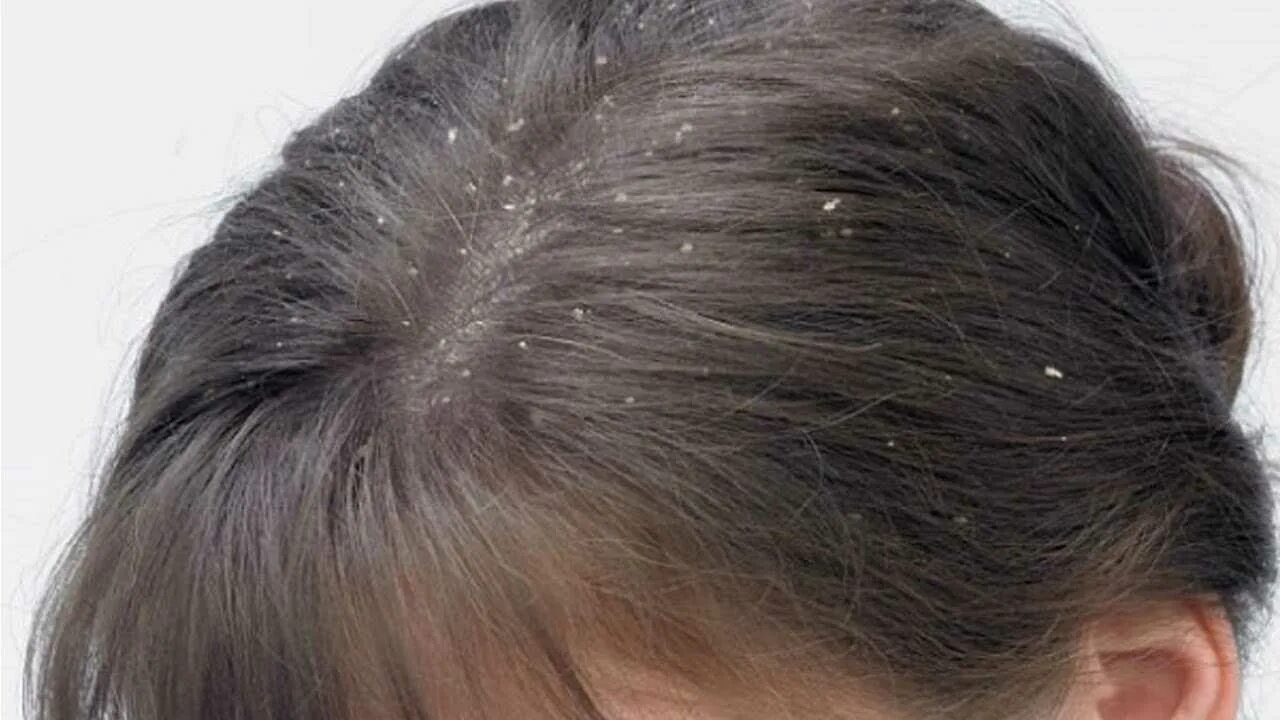 Название кожи головы. Название кожи головы. Асбестовидный себорейный дерматит. Название кожи головы. Асбестовидный себорейный дерматит.