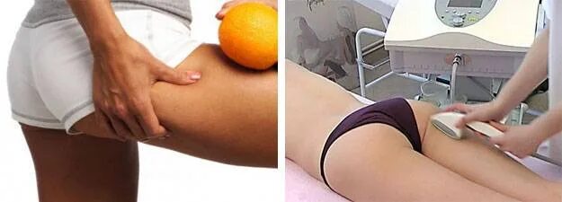 Старвак отзывы до и после Аппаратный массаж Beautylizer до после, фото результатов процедуры Наши работы