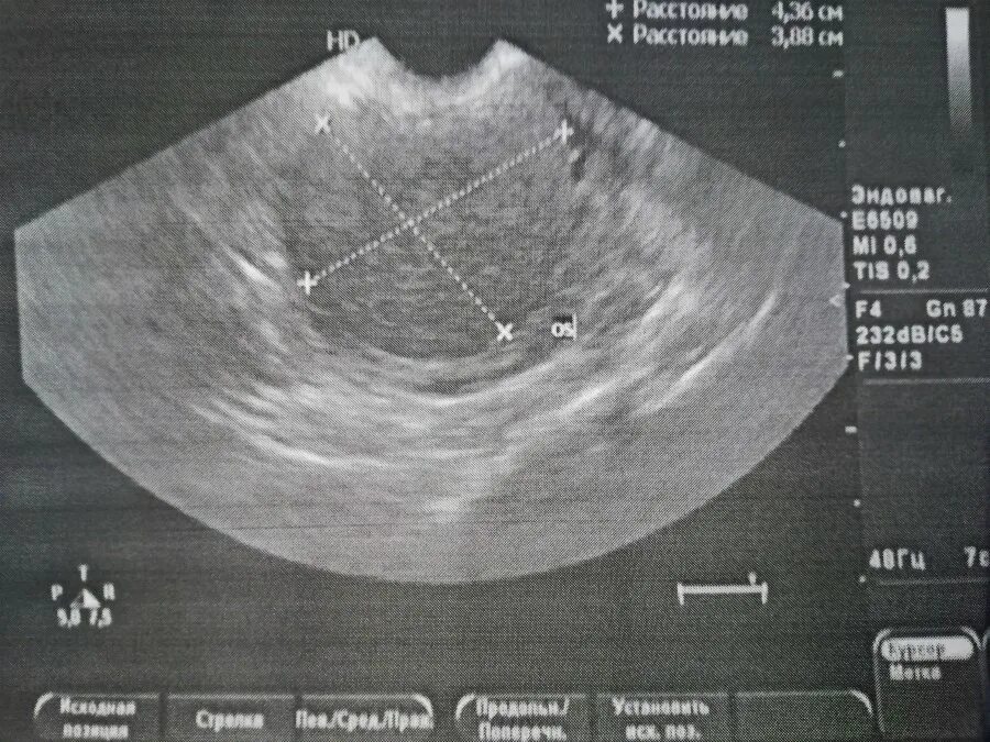 М-Эхо 6.6 мм фолликулометрия. М-Эхо матки на УЗИ. М-Эхо эндометрия. М Эхо на УЗИ. Эндометрия 14 мм