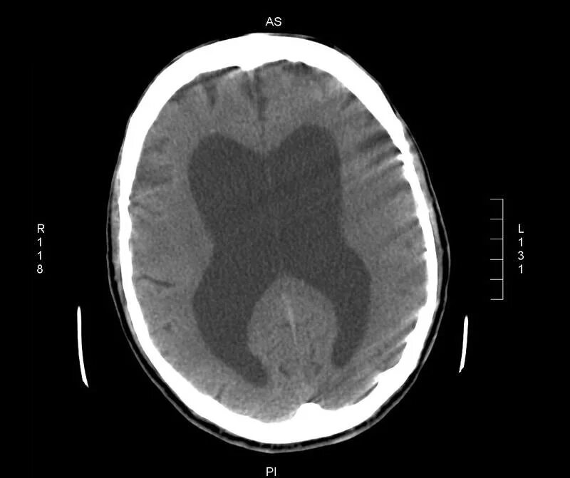 Гидроцефалия головного мозга на кт. Наружная гидроцефалия кт. Кт признаки гидроцефалии мозга. Наружная гидроцефалия головного мозга кт.