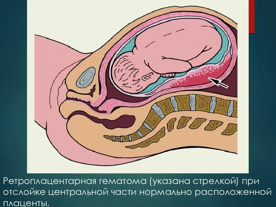 Краевая и Центральная отслойка плаценты. Предлежание плаценты и отслойка нормально расположенной плаценты. Отслойка плаценты патанатомия. Ретроплацентарная отслойка плаценты. Плацента на рубце матки