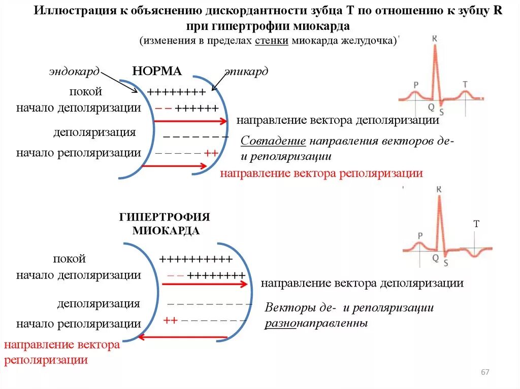 Деполяризация миокарда на ЭКГ. ЭКГ деполяризация и реполяризация. ЭКГ-изменения при гипертрофиях миокарда.. Направление процессов деполяризации желудочков норме:. Умеренные изменения реполяризации