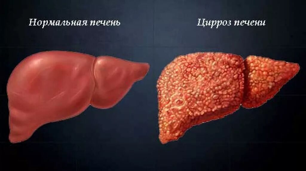 На фоне диффузных изменений