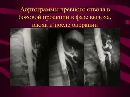 Стеноз чревного ствола