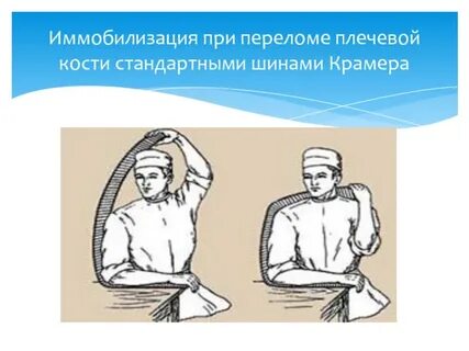 Иммобилизация плеча
