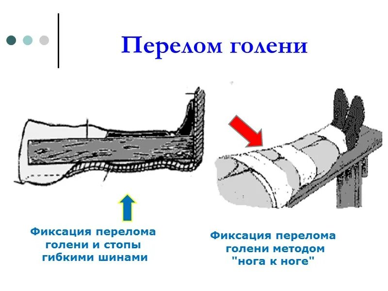 Способы и особенности фиксации конечностей. Перелом голени фиксация. Фиксация шины при переломе голени. Фиксация конечностей при переломах.