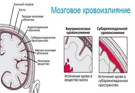 От чего происходит кровоизлияние