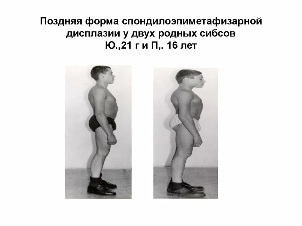 2. 2. Дисплазия 87. Метафизарная дисплазия у детей. Спондилоэпифизарной дисплазии.