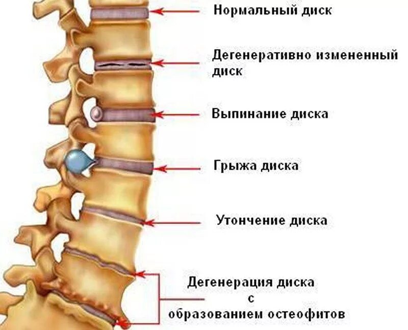 Боли в спине протрузии