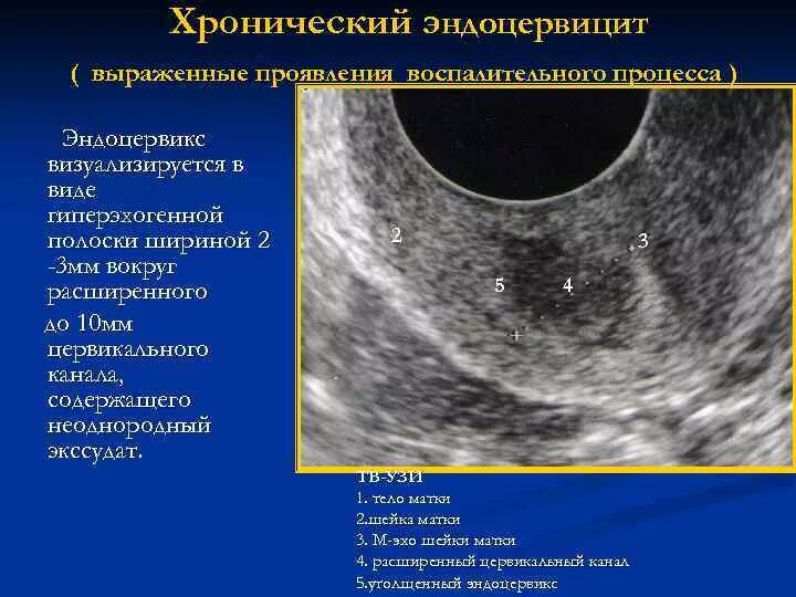 Хронический эндоцервицит что это. Шейка матки эндоцервикс.