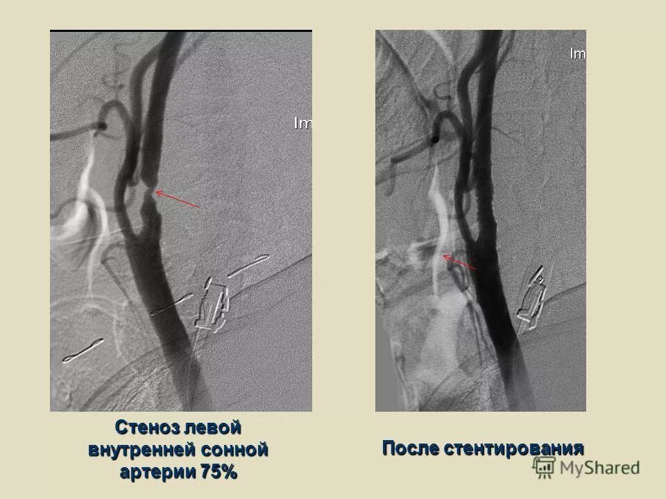 Стеноз устья правой ВСА до 70. Стеноз сонной артерии 70 процентов. Стеноз внутренней сонной артерии стентирование.