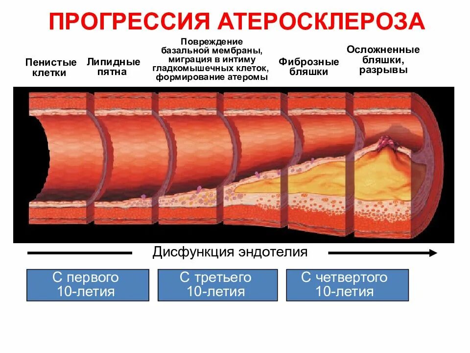 ИБС атеросклеротическая бляшка. Стадии атеросклеротической бляшки. Стадии формирования атеросклеротической бляшки. Стадии развития атеросклероза.