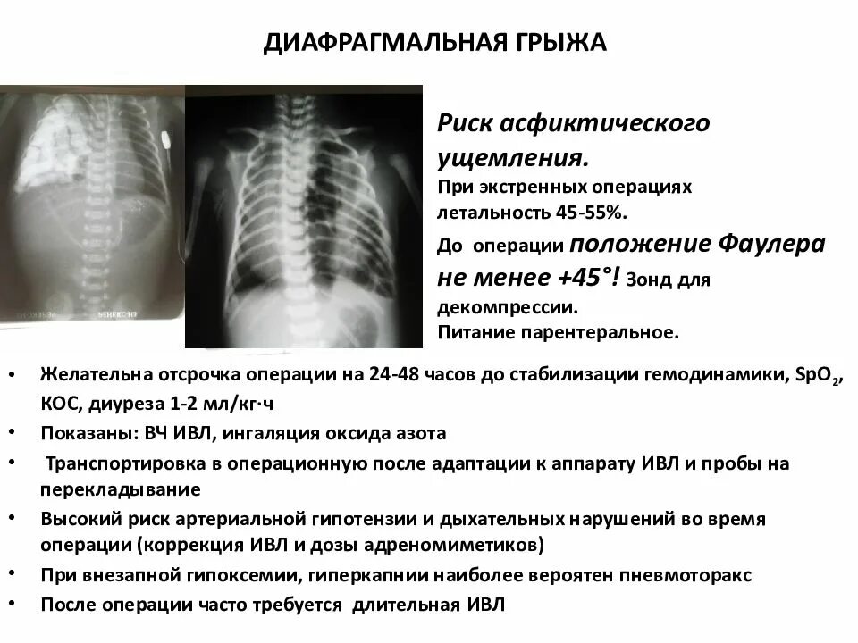 Симптомы диафрагмальной грыжи