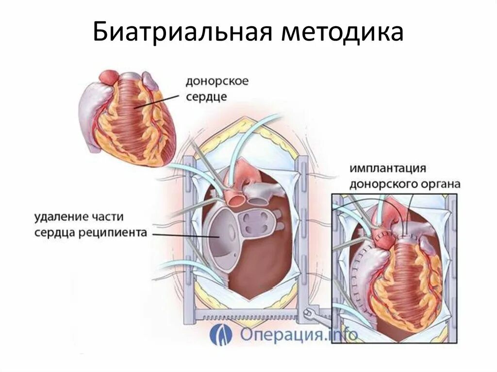 Биатриальная методика пересадки сердца. Техника ортотопической трансплантации сердца. Схема пересадки сердца. Донорство сердца