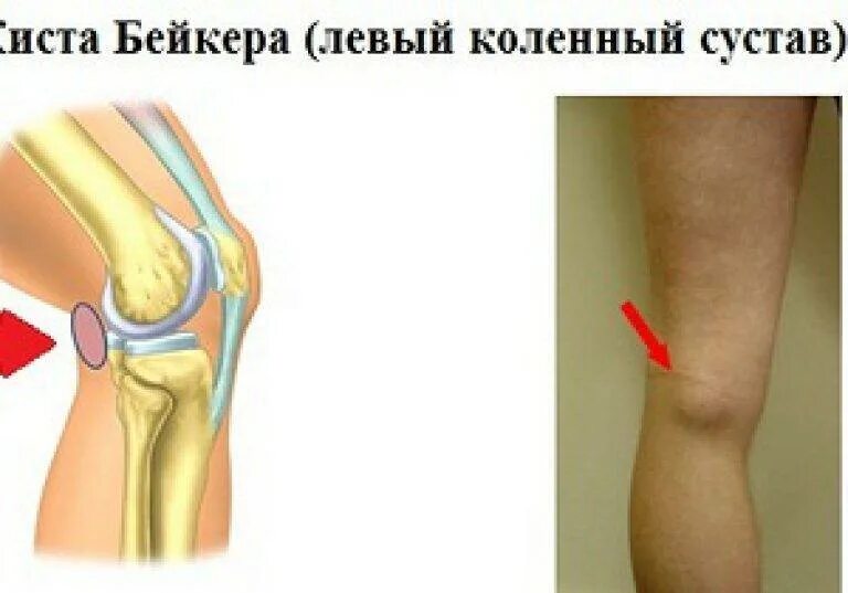 Как лечить подколенную кисту