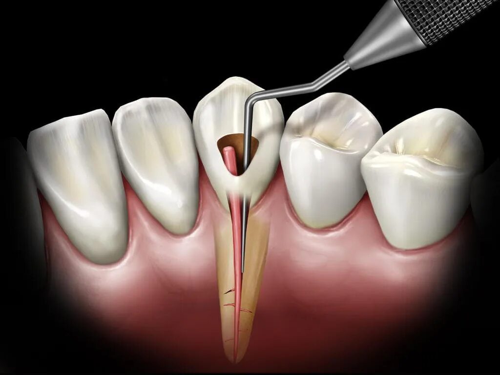 Root canal. 4 Канальный пульпит зуба. Многокорневой пульпит.