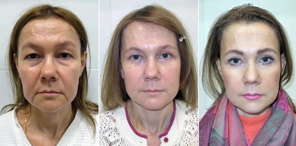 Последствия лифтинга