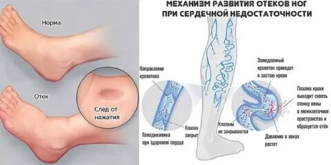 Отеки и боль в ногах причины