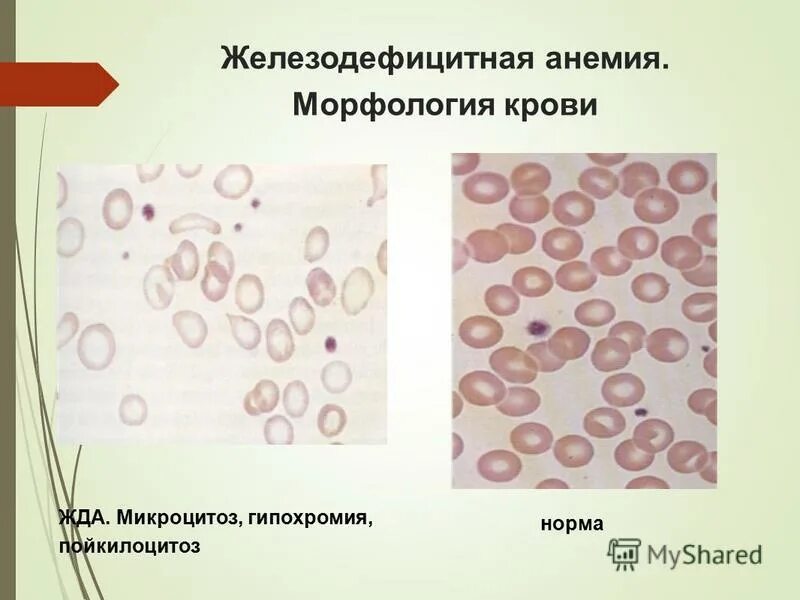 гипохромия и микроцитоз характерны для. гипохромия и гиперхромия. микроцитоз пойкилоцитоз. анемия микроцитоз гипохромия. железодефицитная анемия картина периферической крови.
