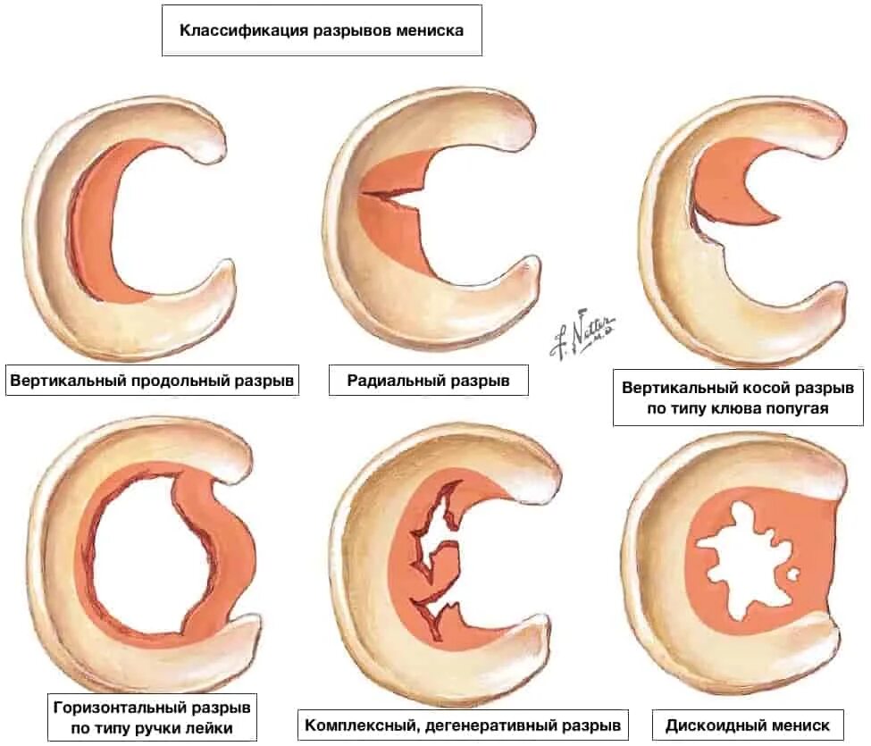 Типы разрывов мениска. Косо горизонтальный разрыв медиального мениска 3 степени. Разрыв заднего рога мениска мениск коленного сустава. Задний Рог медиального мениска 3 степени. Повреждениезаднего рога медиалтного мениска 3а степени.