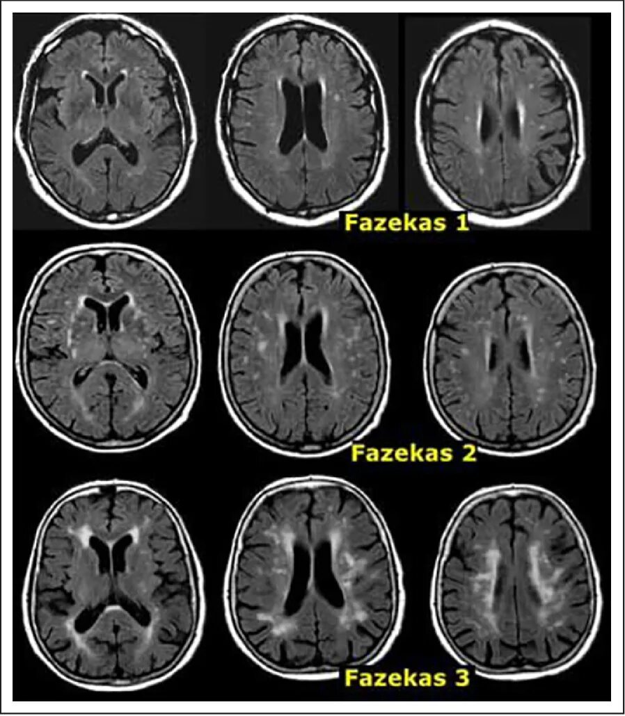 Микроангиопатия головного мозга fazekas. Церебральная микроангиопатия Fazekas 1 головного мозга что это такое. Fazekas III мрт. Церебральная микроангиопатия головного мозга кт. Церебральная микроангиопатия мрт.