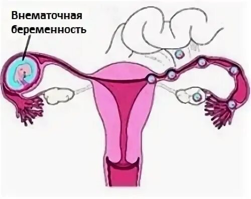 Внематочная беременность операция сколько