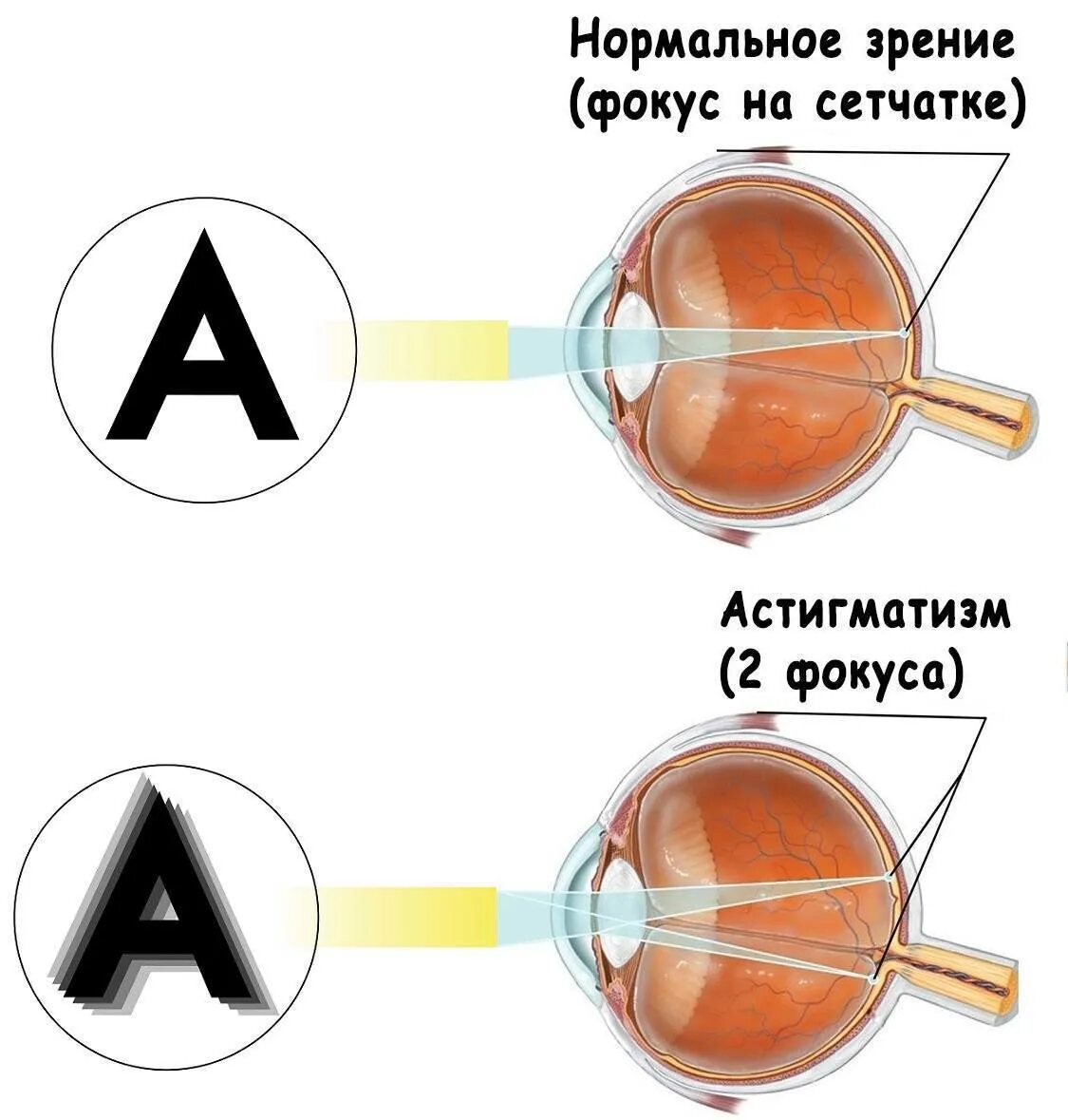 Вылечит ли близорукость операция. Гиперметропический астигматизм у детей. Сложный миопический астигматизм левого глаза. Смешанный миопический астигматизм. Что такое астигматизм зрения у детей.