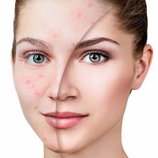 Acne removing